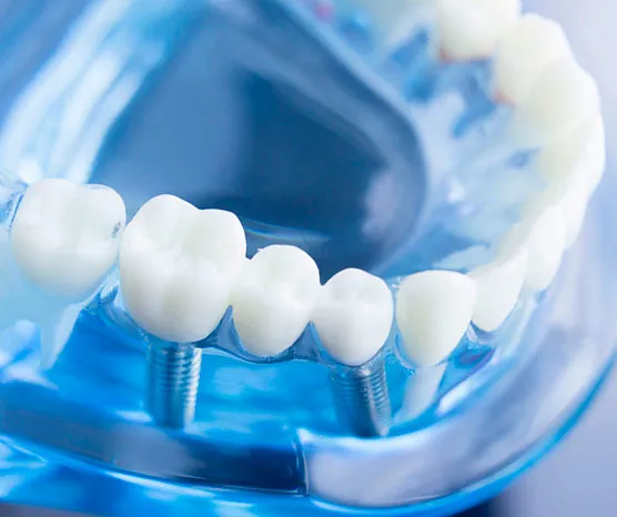 Implantes